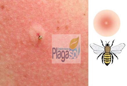 5 Picaduras M s Comunes De Insectos